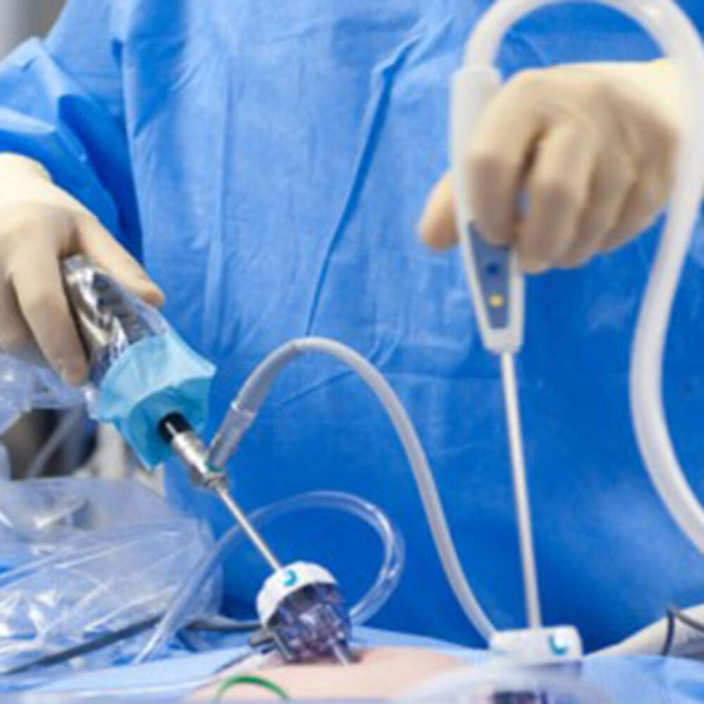 laparoscopy